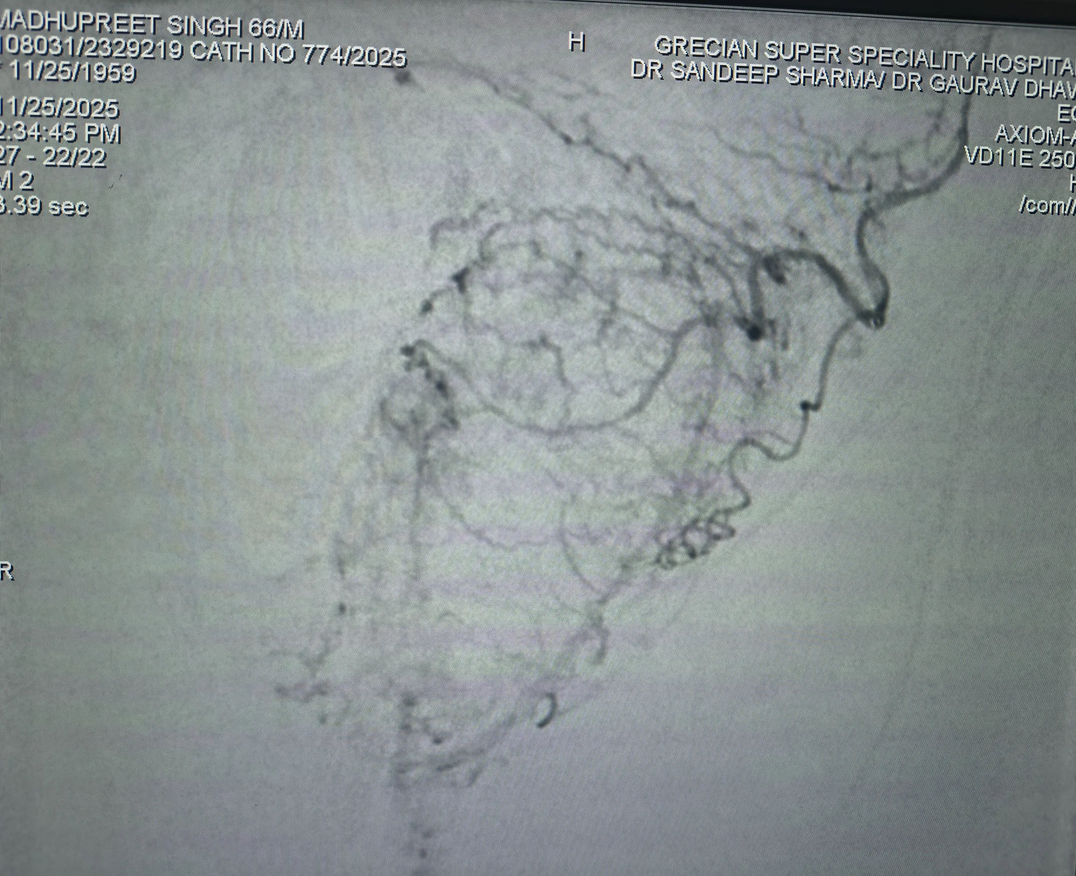 Left Prostatic Artery